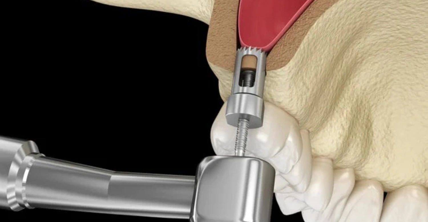 Sinus Perforation In blog